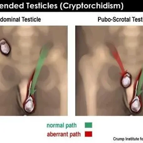 unDescended Testicals