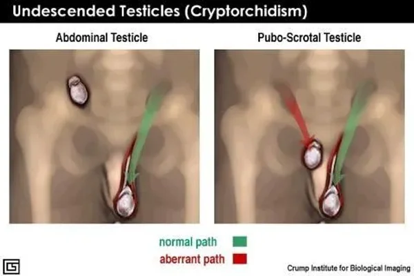 unDescended Testicals