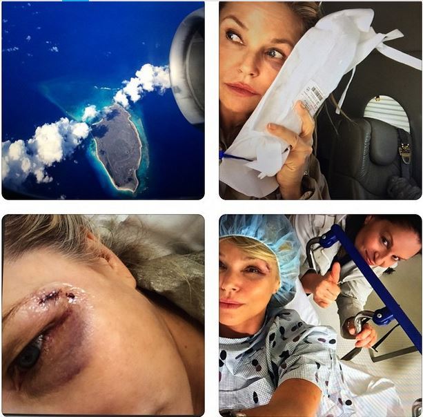 Christie Brinkley Injured Trying to Save Bird